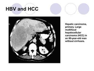HBV and HCC
Hepatic carcinoma,
primary. Large
multifocal
hepatocellular
carcinoma (HCC) in
an 80-year-old man
without cirrhosis.
 
