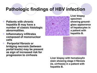 Pathologic findings of HBV infection
 Patients with chronic
hepatitis B may have a
number of classic histologic
abnormalities.
 Inflammatory infiltrates
composed of mononuclear
cells
 Periportal fibrosis or
bridging necrosis (between
portal tracts) may be present
as sign of increased risk for
progression to cirrhosis
Liver biopsy
specimen
showing ground-
glass appearance
of hepatocytes in
a patient with
hepatitis B.
Liver biopsy with hematoxylin
stain showing stage 4 fibrosis
(ie, cirrhosis) in a patient with
hepatitis B.
 