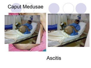 Caput Medusae
Ascitis
 