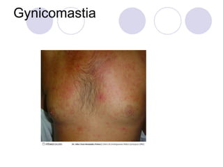Gynicomastia
 