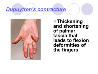 Dupuytren's contracture
Thickening
and shortening
of palmar
fascia that
leads to flexion
deformities of
the fingers.
 