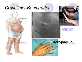 Cruveilhier-Baumgarten
Asterixis
acropaquia_
 