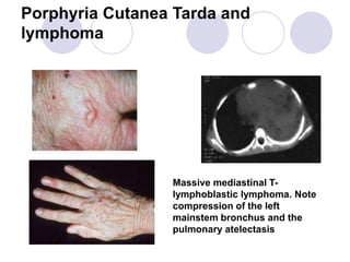 Porphyria Cutanea Tarda and
lymphoma
Massive mediastinal T-
lymphoblastic lymphoma. Note
compression of the left
mainstem bronchus and the
pulmonary atelectasis
 