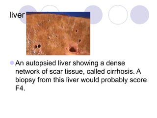 liver biopsies.
An autopsied liver showing a dense
network of scar tissue, called cirrhosis. A
biopsy from this liver would probably score
F4.
 