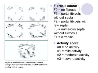  Fibrosis score:
F0 = no fibrosis
F1 = portal fibrosis
without septa
F2 = portal fibrosis with
few septa
F3 = numerous septa
without cirrhosis
F4 = cirrhosis
 Activity score:
A0 = no activity
A1 = mild activity
A2 = moderate activity
A3 = severe activity
 