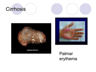 Cirrhosis
Palmar
erythema
 