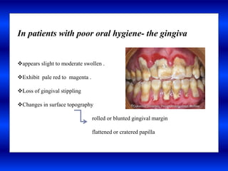 In patients with poor oral hygiene- the gingiva
appears slight to moderate swollen .
Exhibit pale red to magenta .
Loss of gingival stippling
Changes in surface topography
rolled or blunted gingival margin
flattened or cratered papilla
 