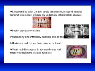 Infection
Long standing cases , in low grade inflamation,thickened ,fibrotic
marginal tissues may obscure the underlying inflammatory changes.
Pocket depths are variable.
suprabony and intrabony pockets can be found
Horizontal and vertical bone loss can be found.
Tooth mobility appears in advanced cases with
extensive attachment loss and bone loss
 