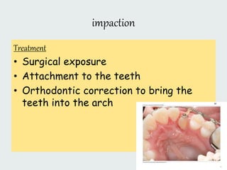 impaction
Treatment
• Surgical exposure
• Attachment to the teeth
• Orthodontic correction to bring the
teeth into the arch
 