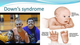 Down’s syndrome
 