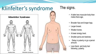 Klinfelter’s syndrome
 