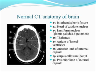 Normal CT anatomy of brain
23: Interhemispheric fissure
24: Head of caudate nucleus
25: Lentiform nucleus
(globus pallidus & putamen)
26: Thalamus
27: Atrium of lateral
ventricles
28: Anterior limb of internal
capsule
29: corpus callosum (body)
30: Posterior limb of internal
capsule
 