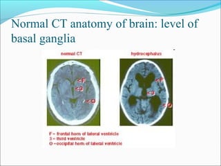 Normal CT anatomy of brain: level of
basal ganglia
 