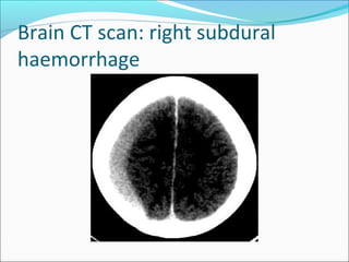 Brain CT scan: right subdural
haemorrhage
 