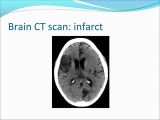 Brain CT scan: infarct
 