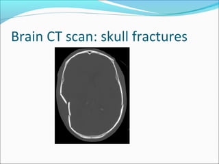 Brain CT scan: skull fractures
 