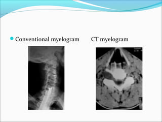 Conventional myelogram CT myelogram
 