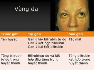Vàng da
Trước gan Tại gan Sau gan
Tán huyết Gan  lấy bilirubin tự do
Gan  kết hợp bilirubin
Gan  bài tiết bilirubin
Tắc mật
Tăng bilirubin
tự do trong
huyết thanh
Bilirubintự do và kết
hợp đều tăng trong
huyết thanh
Tăng bilirubin
kết hợp trong
huyết thanh
 