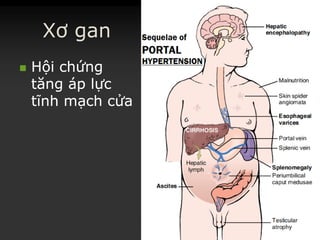 Xơ gan
 HộiHội chứngchứng
tăngtăng ápáp lựclực
tĩnhtĩnh mạchmạch cửacửa
 