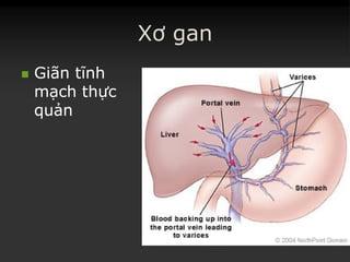 Xơ gan
 GiãnGiãn tĩnhtĩnh
mạchmạch thựcthực
quảnquản
 