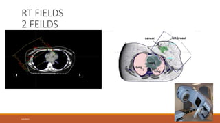 Rt Field a brief overview about management of ca breast.pptx