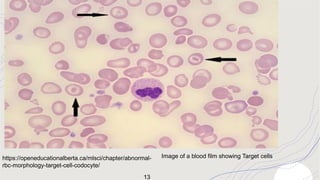 Laboratory investigations of sickle cell anaemia | PPTX