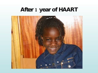 After 1 year of HAART 