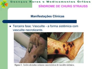 SÍNDROME DE CHURG STRAUSS


                 Manifestações Clínicas


   Terceira fase: Vasculite - a forma sistêmica com
    vasculite necrotizante.
 