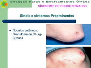 SÍNDROME DE CHURG STRAUSS


        Sinais e sintomas Proeminentes



   Nódulos cutâneos:
    Granuloma de Churg-
    Strauss
 