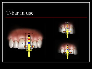 Set Hu-Friedy Chu's Aesthetic Gauges™ - SCHUSET, Strumenti Dentali Estetici, USA - Foto 5