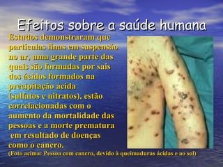 Efeitos sobre a saúde humana Estudos demonstraram que  partículas finas em suspensão  no ar, uma grande parte das  quais são formadas por sais  dos ácidos formados na  precipitação ácida  (sulfatos e nitratos), estão correlacionadas com o  aumento da mortalidade das  pessoas e a morte prematura em resultado de doenças  como o cancro.  (Foto acima: Pessoa com cancro, devido à queimaduras ácidas e ao sol) 