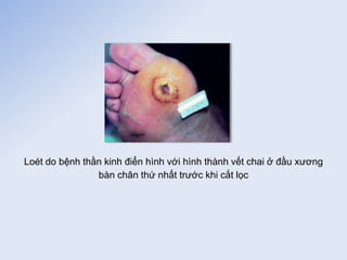 Loét do bệnh thần kinh điển hình với hình thành vết chai ở đầu xương
bàn chân thứ nhất trước khi cắt lọc
 