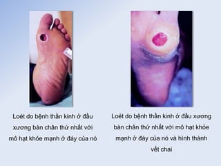 Loét do bệnh thần kinh ở đầu
xương bàn chân thứ nhất với
mô hạt khỏe mạnh ở đáy của nó
Loét do bệnh thần kinh ở đầu xương
bàn chân thứ nhất với mô hạt khỏe
mạnh ở đáy của nó và hình thành
vết chai
 