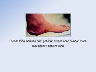 Loét do thiếu máu bên dưới gót chân ở bệnh nhân có bệnh mạch
máu ngoại vi nghiêm trọng
 