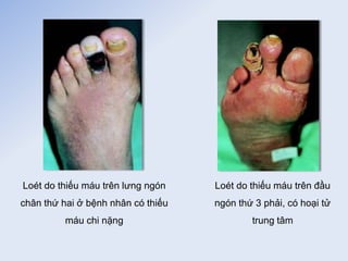Loét do thiếu máu trên lưng ngón
chân thứ hai ở bệnh nhân có thiếu
máu chi nặng
Loét do thiếu máu trên đầu
ngón thứ 3 phải, có hoại tử
trung tâm
 