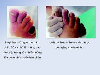 Hoại thư khô ngón thứ năm
phải. Đỏ và phù là những dấu
hiệu đặc trưng của nhiễm trùng
liên quan phía trước bàn chân
Loét do thiếu máu sau khi cắt lọc
gọn gàng chổ hoại thư
 