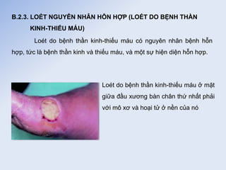 B.2.3. LOÉT NGUYÊN NHÂN HỖN HỢP (LOÉT DO BỆNH THẦN
KINH-THIẾU MÁU)
Loét do bệnh thần kinh-thiếu máu có nguyên nhân bệnh hỗn
hợp, tức là bệnh thần kinh và thiếu máu, và một sự hiện diện hỗn hợp.
Loét do bệnh thần kinh-thiếu máu ở mặt
giữa đầu xương bàn chân thứ nhất phải
với mô xơ và hoại tử ở nền của nó
 