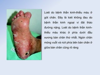 Loét do bệnh thần kinh-thiếu máu ở
gót chân. Đây là loét không đau do
bệnh thần kinh ngoại vi đái tháo
đường nặng. Loét do bệnh thần kinh-
thiếu máu khác ở phía dưới đầu
xương bàn chân thứ nhất. Ngón chân
móng vuốt và nứt phía bên bàn chân ở
giữa bàn chân cũng rõ ràng
 