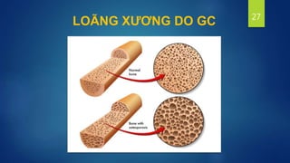 27
LOÃNG XƯƠNG DO GC
 