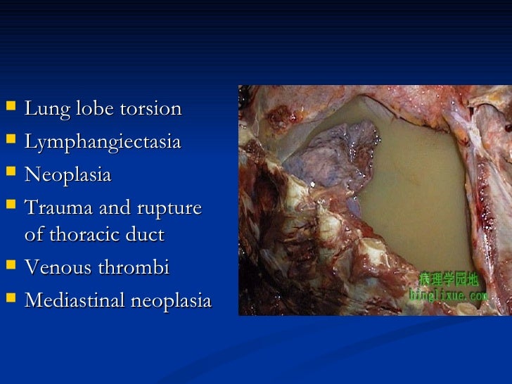 Chylothorax