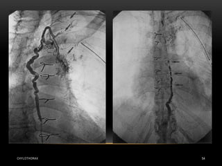 CHYLOTHORAX 54
 