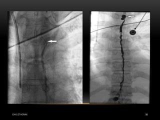 CHYLOTHORAX 56
 