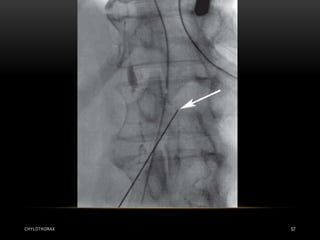 CHYLOTHORAX 57
 