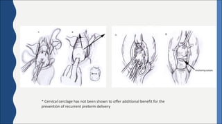 *	Cervical	cerclage	has	not	been	shown	to	offer	additional	benefit	for	the	
prevention	of	recurrent	preterm	delivery
 