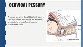CERVICAL PESSARY
• A	cervical	pessary	is	thought	to	alter	the	axis	of	
the	cervical	canal	and	displace	the	weight	of	
pregnant	uterus	away	from	the	cervix.
• Still	under	research.
 