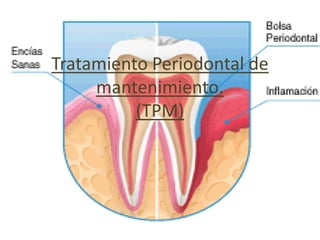 Tratamiento Periodontal de
     mantenimiento.
          (TPM)
 