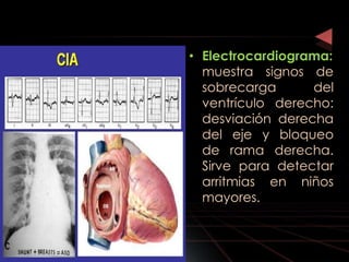 • Electrocardiograma:
  muestra signos de
  sobrecarga      del
  ventrículo derecho:
  desviación derecha
  del eje y bloqueo
  de rama derecha.
  Sirve para detectar
  arritmias en niños
  mayores.
 