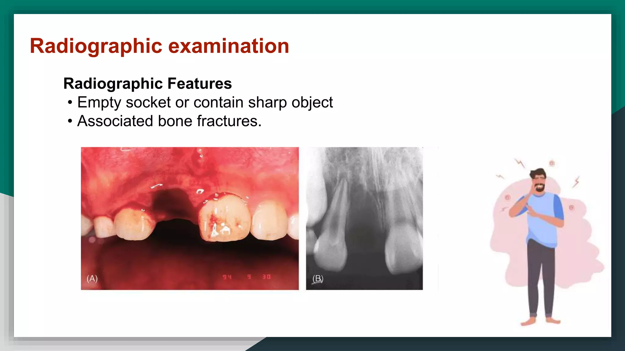 Radiographic examination
Radiographic Features
• Empty socket or contain sharp object
• Associated bone fractures.
 