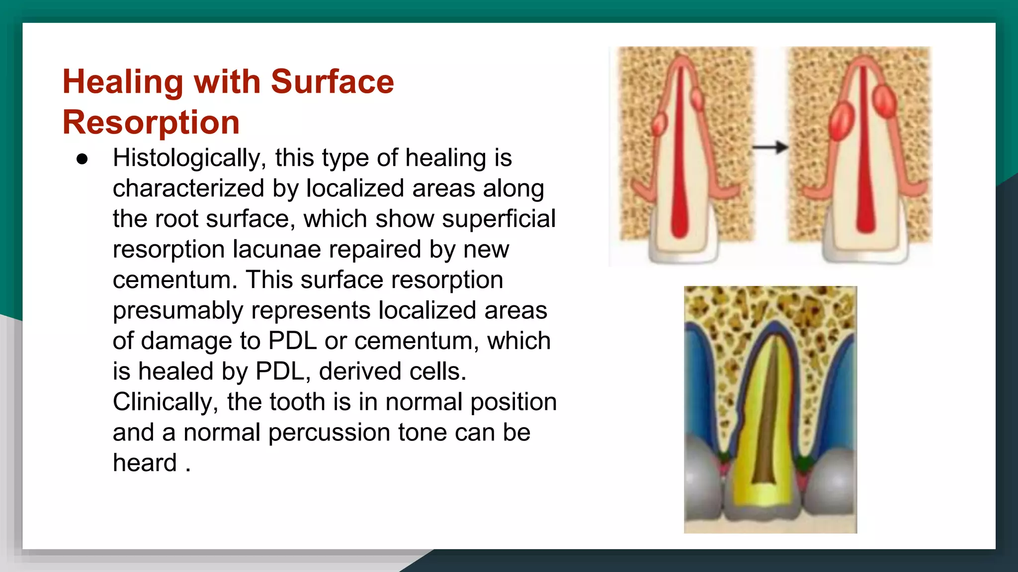 Healing with Surface
Resorption
● Histologically, this type of healing is
characterized by localized areas along
the root surface, which show superficial
resorption lacunae repaired by new
cementum. This surface resorption
presumably represents localized areas
of damage to PDL or cementum, which
is healed by PDL, derived cells.
Clinically, the tooth is in normal position
and a normal percussion tone can be
heard .
 