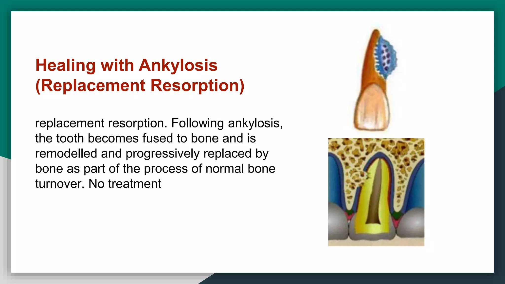 Healing with Ankylosis
(Replacement Resorption)
replacement resorption. Following ankylosis,
the tooth becomes fused to bone and is
remodelled and progressively replaced by
bone as part of the process of normal bone
turnover. No treatment
 